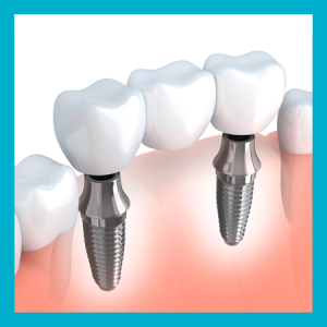 implantologia impianti denti